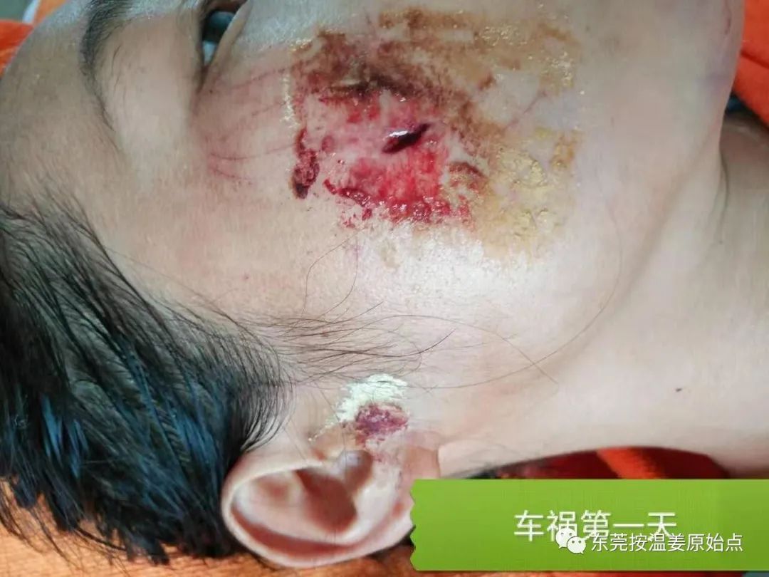 原始點處理肋骨斷7根，胸腔積液等
