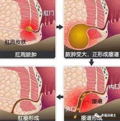 肛瘺案例