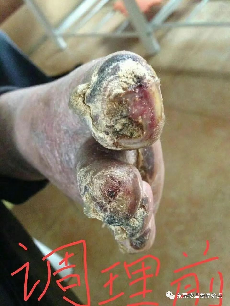 原始點處理糖尿病，腳趾腐爛不愈合