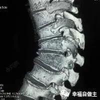 胸椎骨折半個月恢復案例