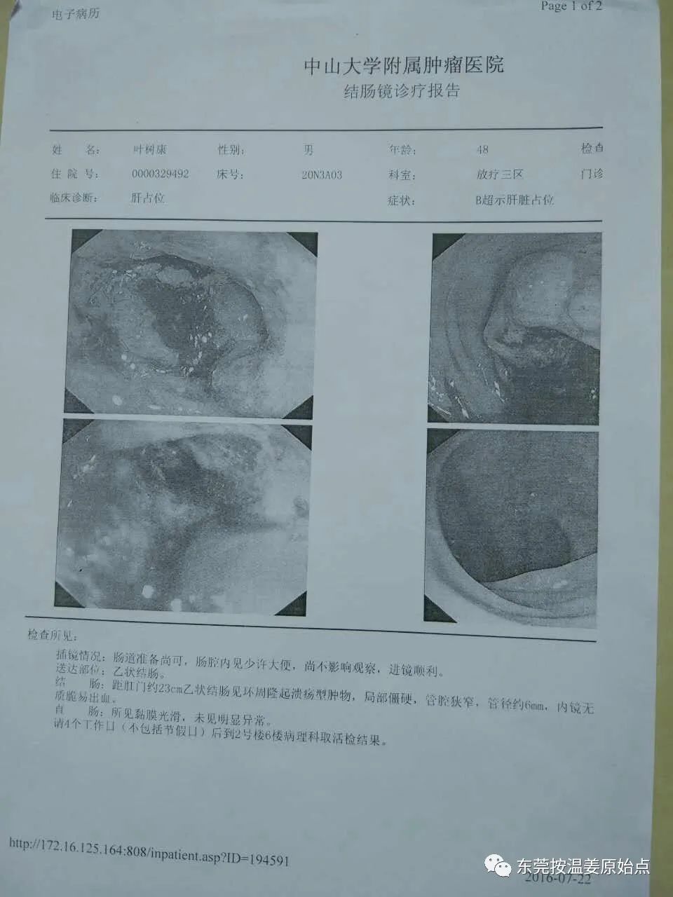 結腸癌、肝轉移、肺轉移