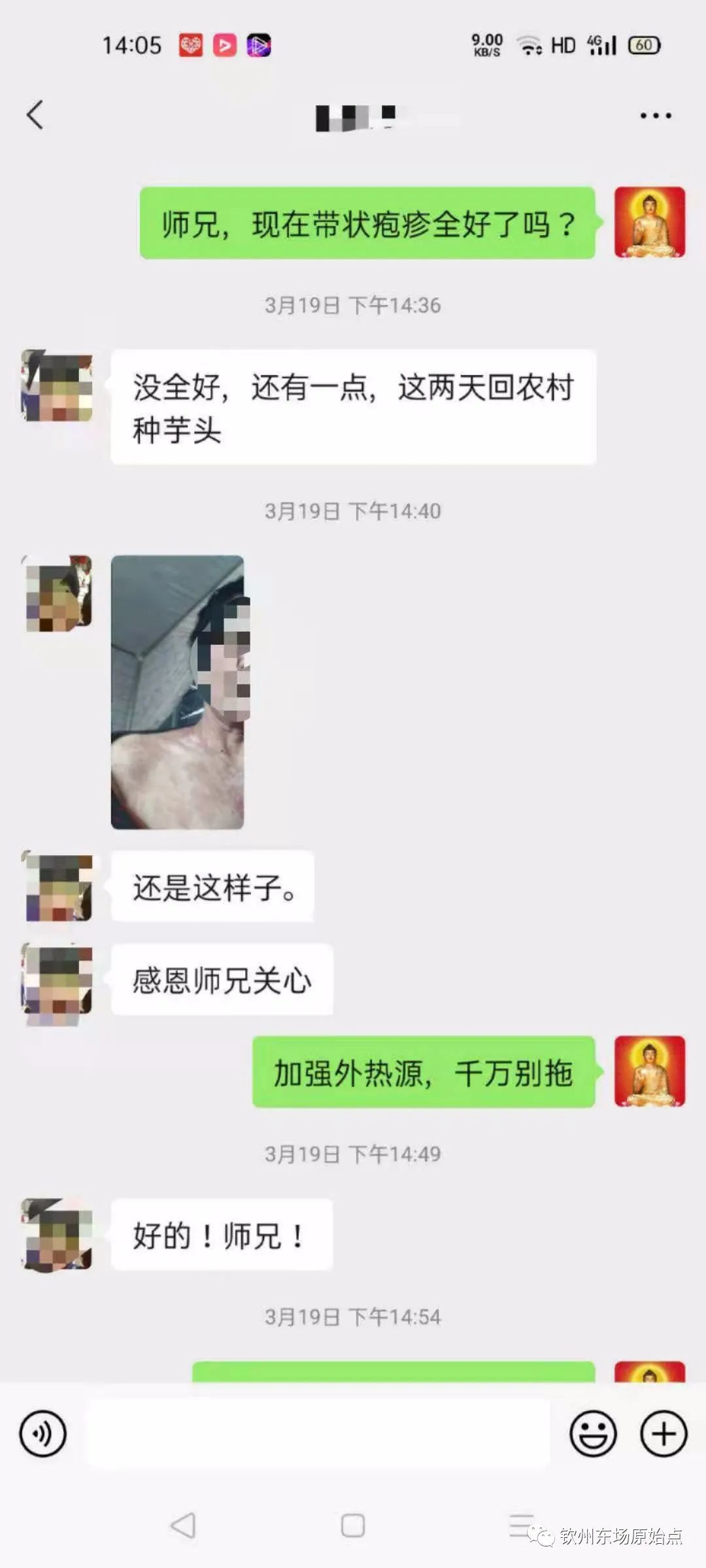 帶狀皰疹案例