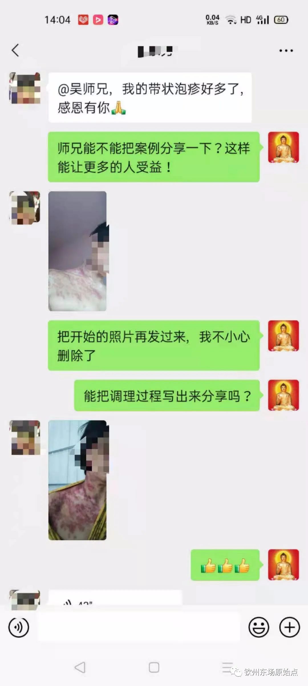 帶狀皰疹案例