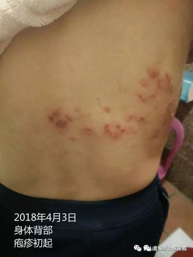 帶狀皰疹案例兩則