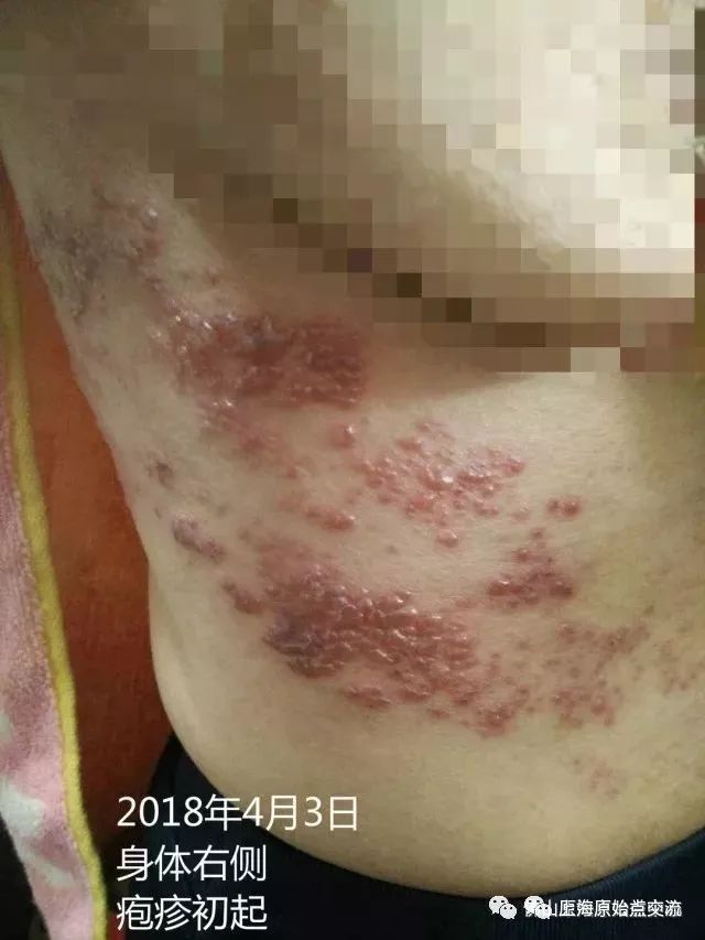 帶狀皰疹案例兩則