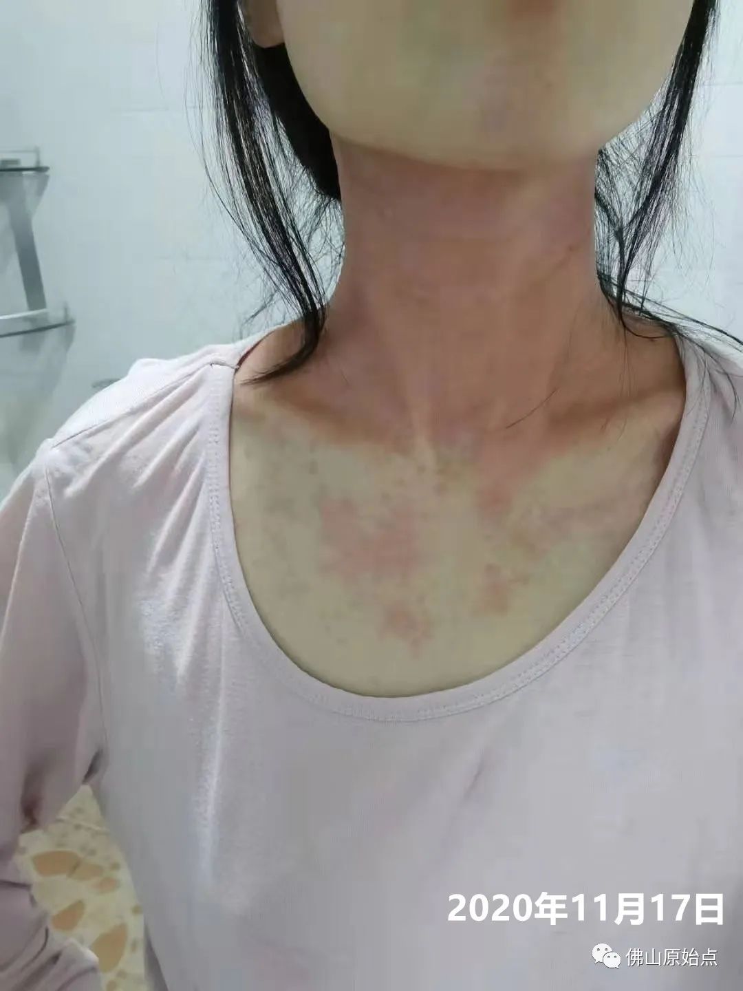 原始點調理紅斑蕁麻疹案例 原始點調理紅斑蕁麻疹案例