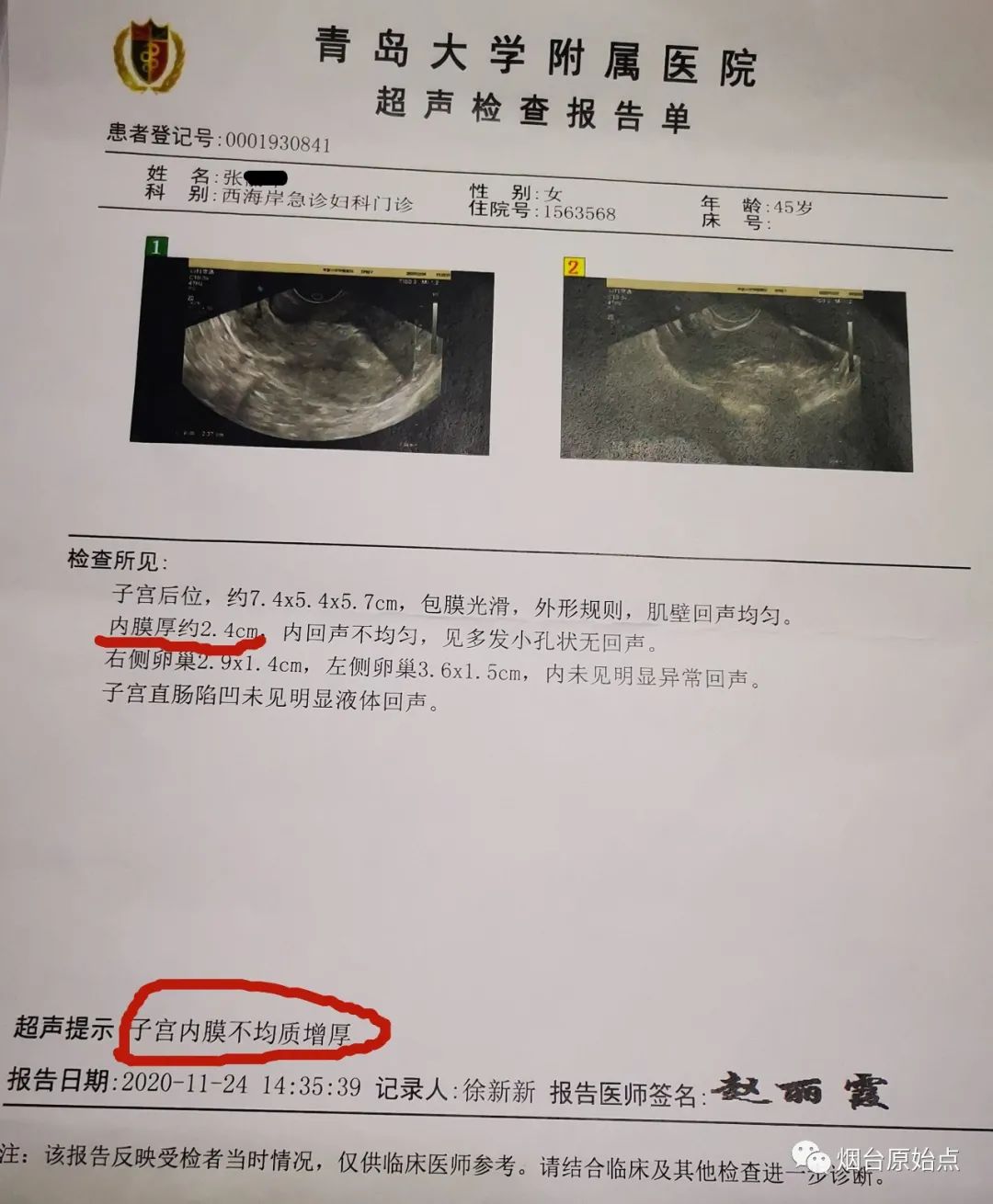 子宮內膜增厚案例