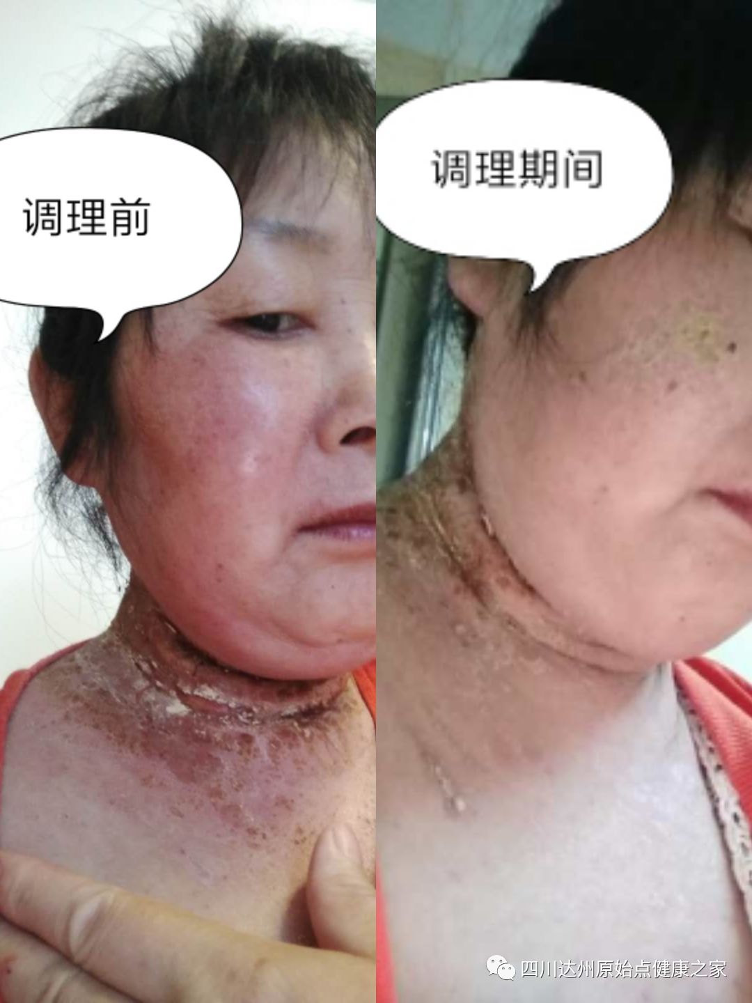【原始點案例】原始點調理神經性皮炎 【原始點案例】原始點調理神經性皮炎