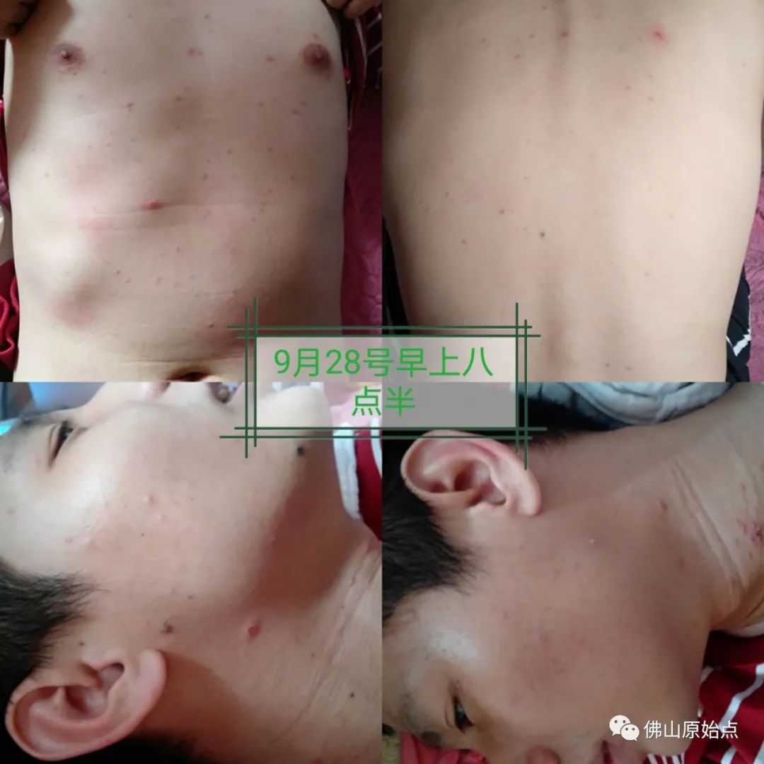原始點調理水痘案例 原始點調理水痘案例