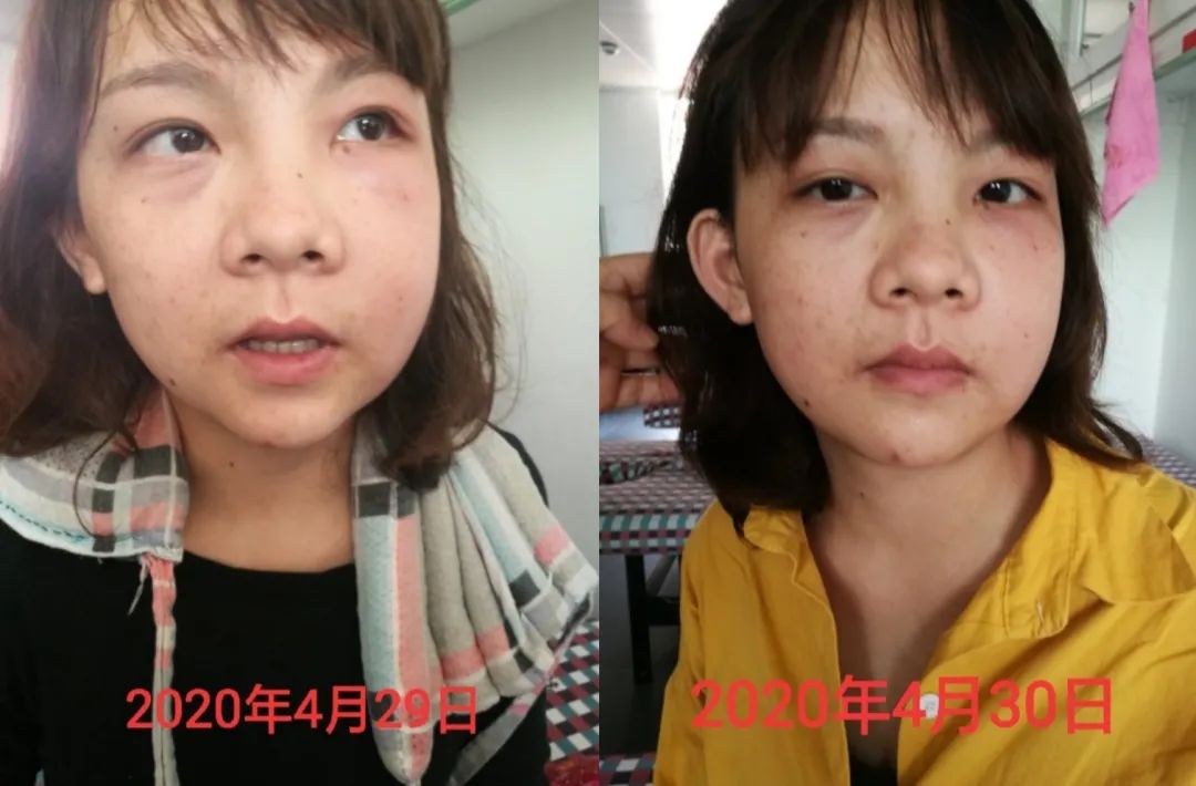 廣州譚樂梅原始點調理牙痛、臉腫案例-七不姜 生姜養生網-明德CSA生態姜園&明安農業