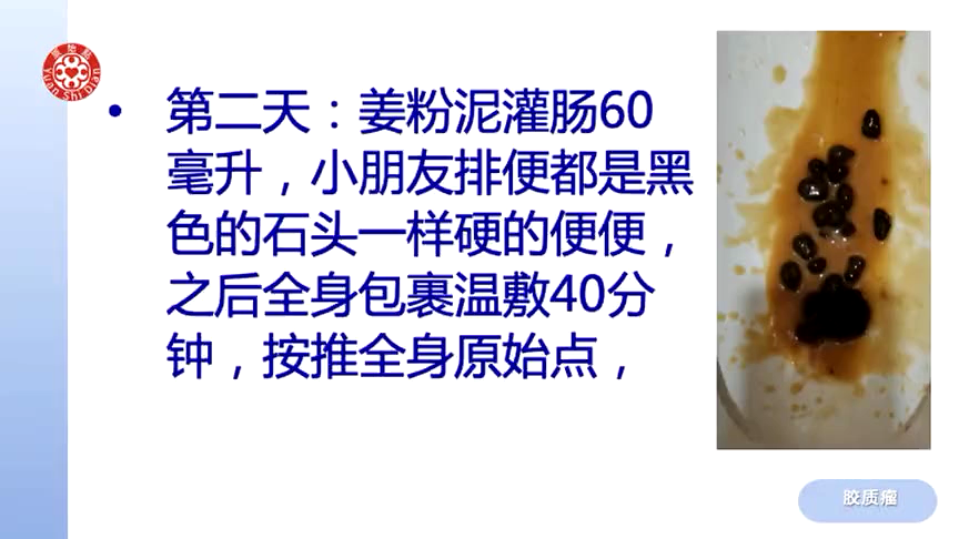 提問答疑-膠質瘤 4歲小男孩膠質瘤案例分析2021.3.7-3.14 3.28-七不姜 生姜養生網-明德CSA生態姜園&明安農業