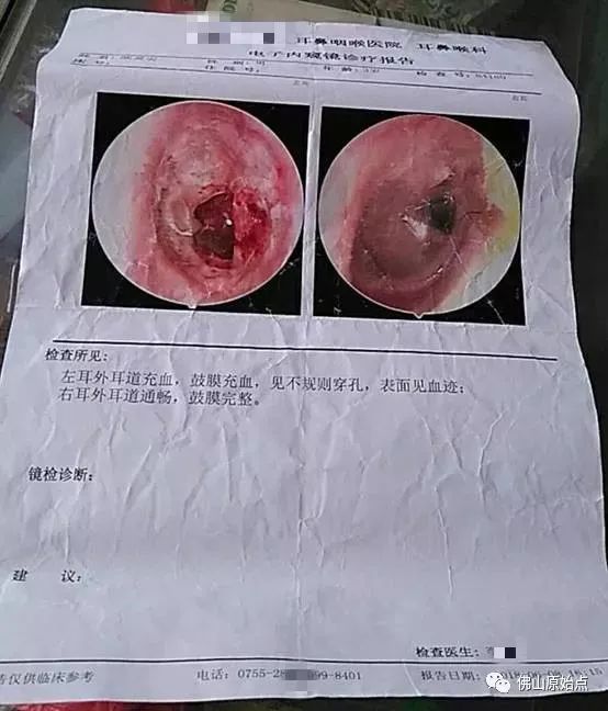 原始點康復耳膜穿孔與失聰 原始點康復耳膜穿孔與失聰